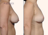 profile view | before and after breast lift photos by Dr. John Burns