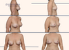 before and after breast lift photos by Dr. John Burns