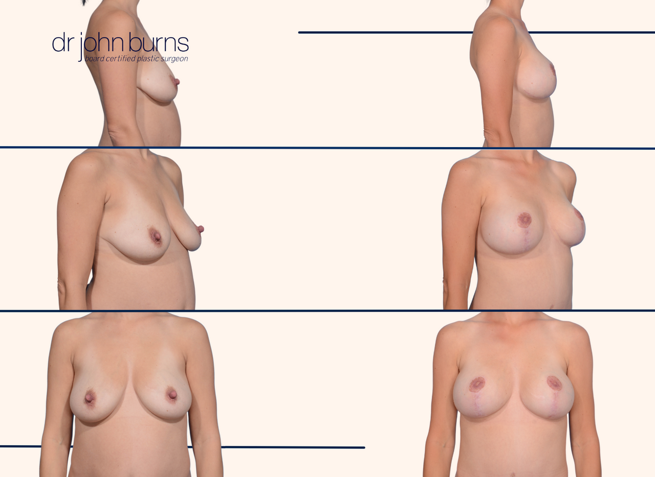 before and after breast lift with implants by Dr. John Burns