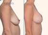 profile view | before and after breast lift with implants by Dr. John Burns
