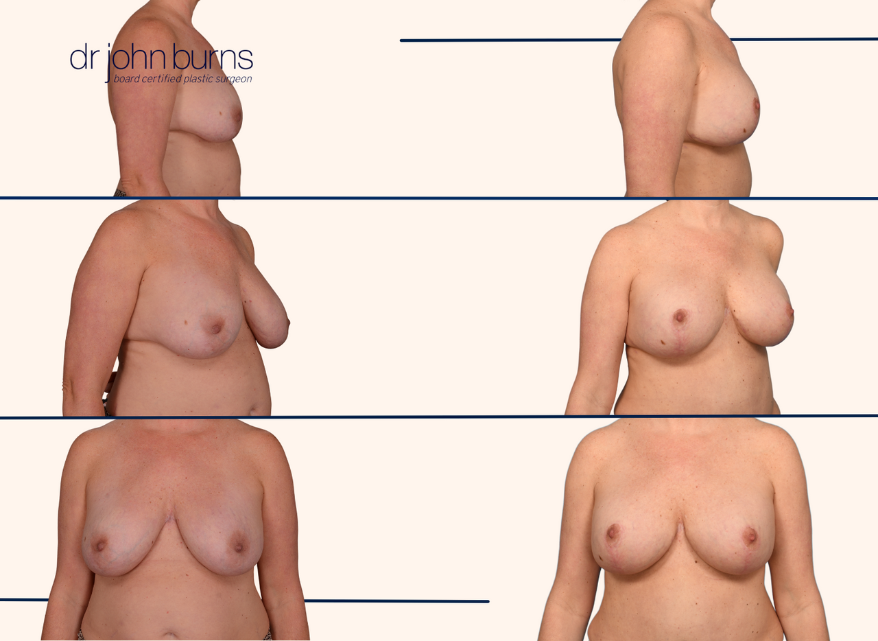 Before and after | Breast lift with breast implant replacement by Dr. John Burns