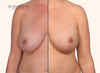 splitscreen | Before and after breast lift with implant replacement