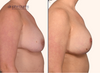 profile view | before and after breast lift with implant replacement