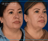 45 Degree View | Before and After Neck Lift with Lipo by Dallas Plastic Surgeon, Dr. John Burns