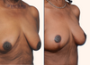 Right 45 degrees | Before and after breast lift surgery by Dr. John Burns