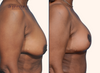 profile view | Before and after breast lift surgery by Dr. John Burns