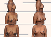Before and after breast lift surgery by Dr. John Burns