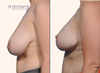 Case 18- Breast Lift