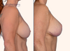 profile view | split screen | before and after breast lift revision with implant replacement