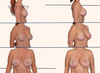 Before and after breast lift with implant replacement by Dr. John Burns