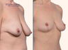 Right 45 degree view | Before and After full breast lift by Dr. John Burns