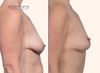 Right profile view | Before and After full breast lift by Dr. John Burns