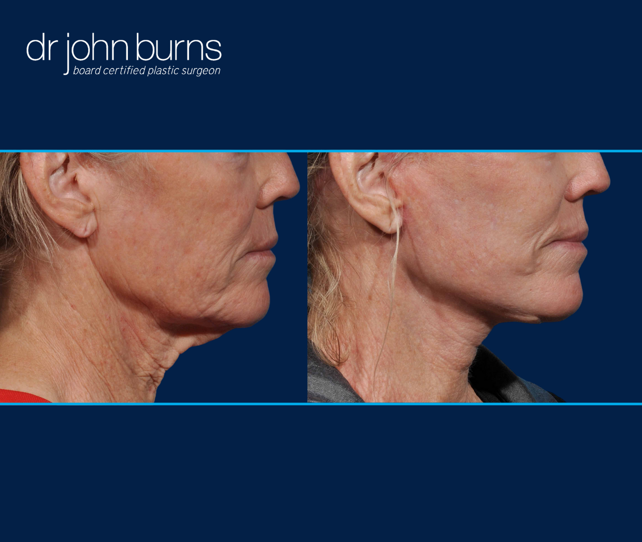 Profile View | Before and After Neck Lift with Lipo by Dallas Plastic Surgeon, Dr. John Burns