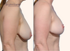 right profile view | before and after breast lift results