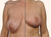 split screen | Before and after breast lift with implants by Dr. John Burns