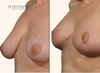 Left 45 Degree View | Before and after breast lift with implants by Dr. John Burns