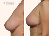 Left Profile View | Before and after breast lift with implants by Dr. John Burns