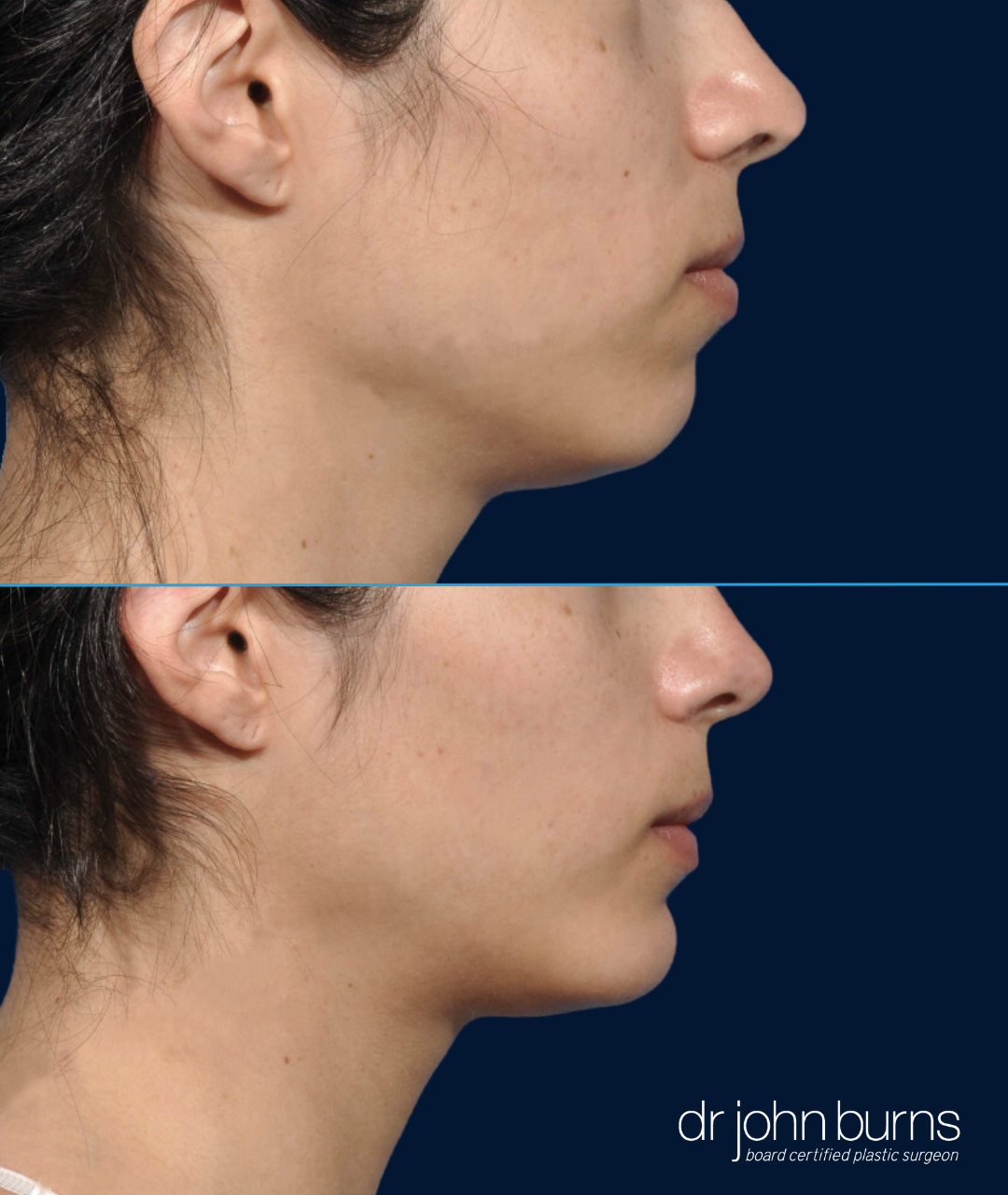 Chin Implant Before and After on Female patient in Dallas by Dr. John Burns