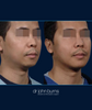 Case 2- Chin Implant Before and After (Male)