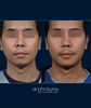 Case 2- Chin Implant (Male)