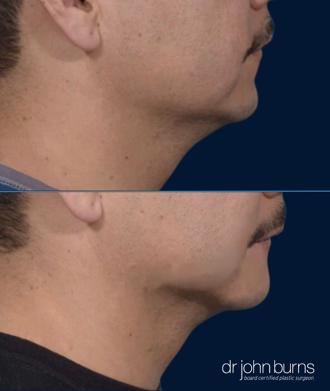 Case 3- Before and After Chin Implant (Male)