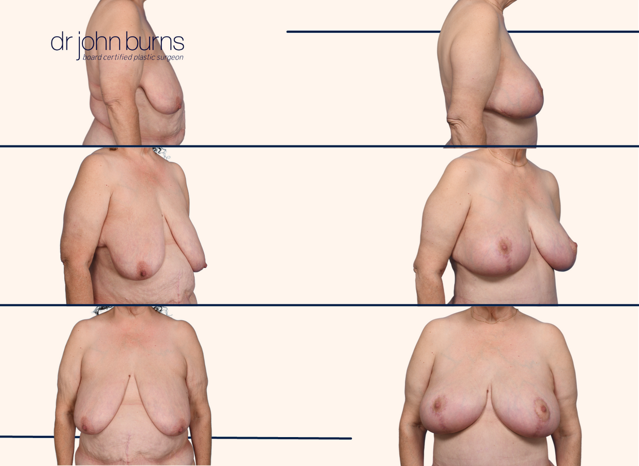 before and after breast lift with breast implant after massive weight loss