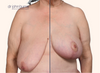 split screen | before and after breast lift results by Dr. John Burns