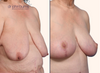 right 45 degree view | before and after breast lift results by Dr. John Burns