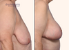 profile view | before and after breast lift results by Dr. John Burns