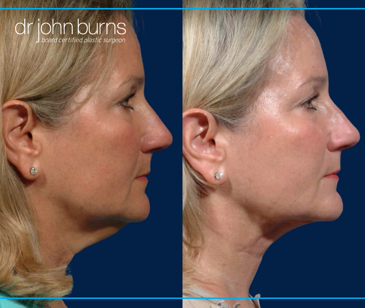 Profile View | Before and After Neck Lift- Dallas Neck Lift by Dr. John Burns