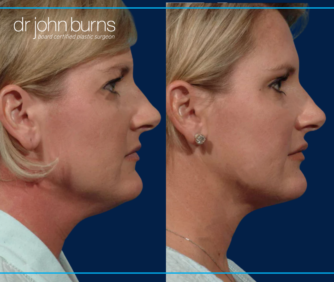 Profile View | Before and After Neck Lift by Dallas Plastic Surgeon, Dr. John Burns