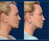 Facelift Revision | Dallas Facelift with  "Lift and Fill" technique with fat grafting to face by Dr. John Burns