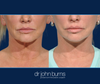 Facelift Revision, "Lift and Fill" Facelift with fat grafting to face by Dr. John Burns