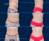 Revision Tummy Tuck | Before and After | By Dallas Plastic Surgeon Dr. John Burns