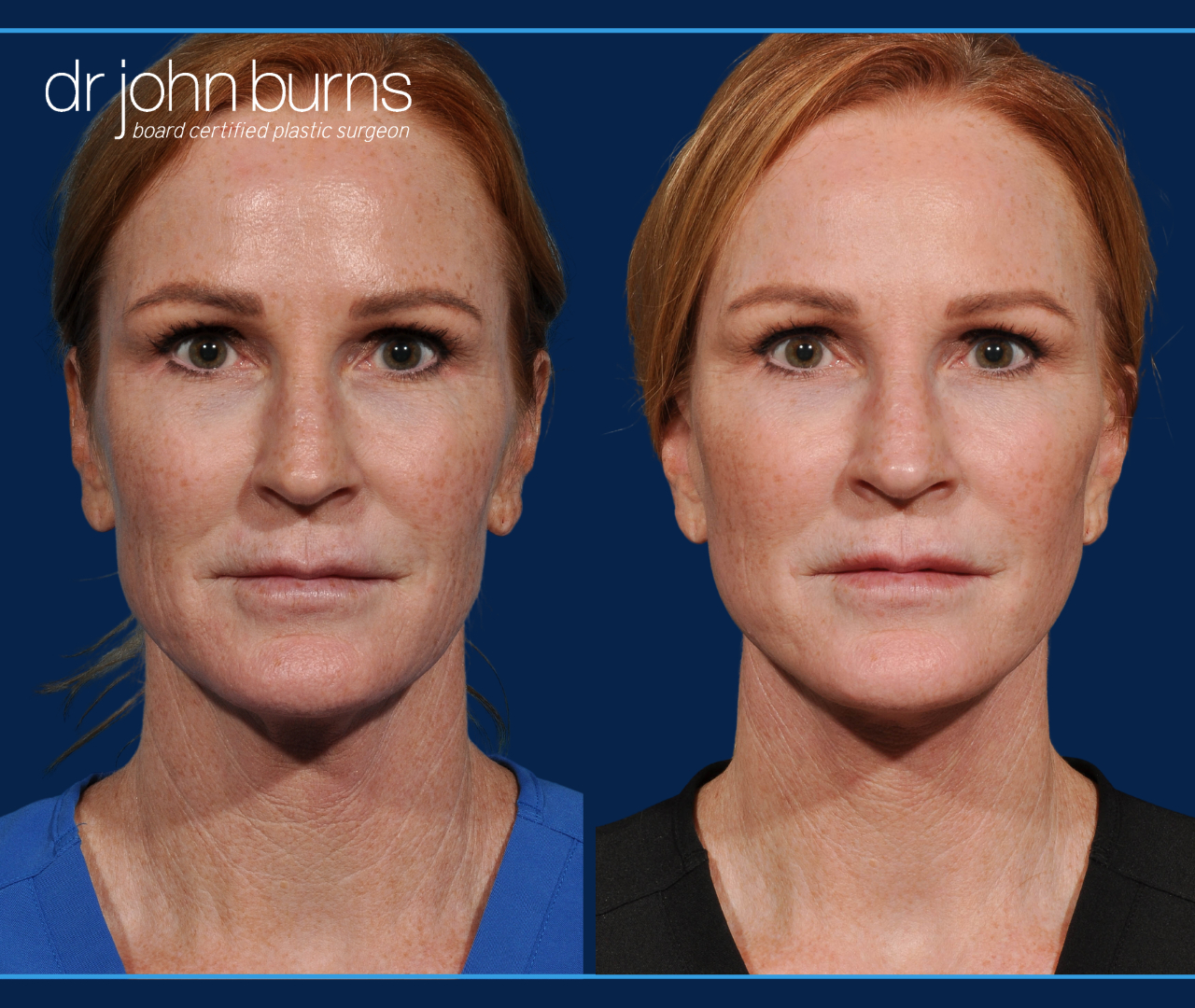 Full Facelift Before & After by Dr. John Burns