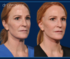 45 degree angle, Full Facelift Before and After by Dr. John Burns