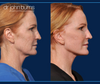 Profile View, Full Facelift Before and After by Dr. John Burns