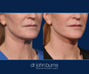 Up close, Jawline and neck detail, full facelift results by Dr. John Burns