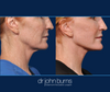 Up close, jawline and neck detail, Before & After Full Facelift by Dr. John Burns