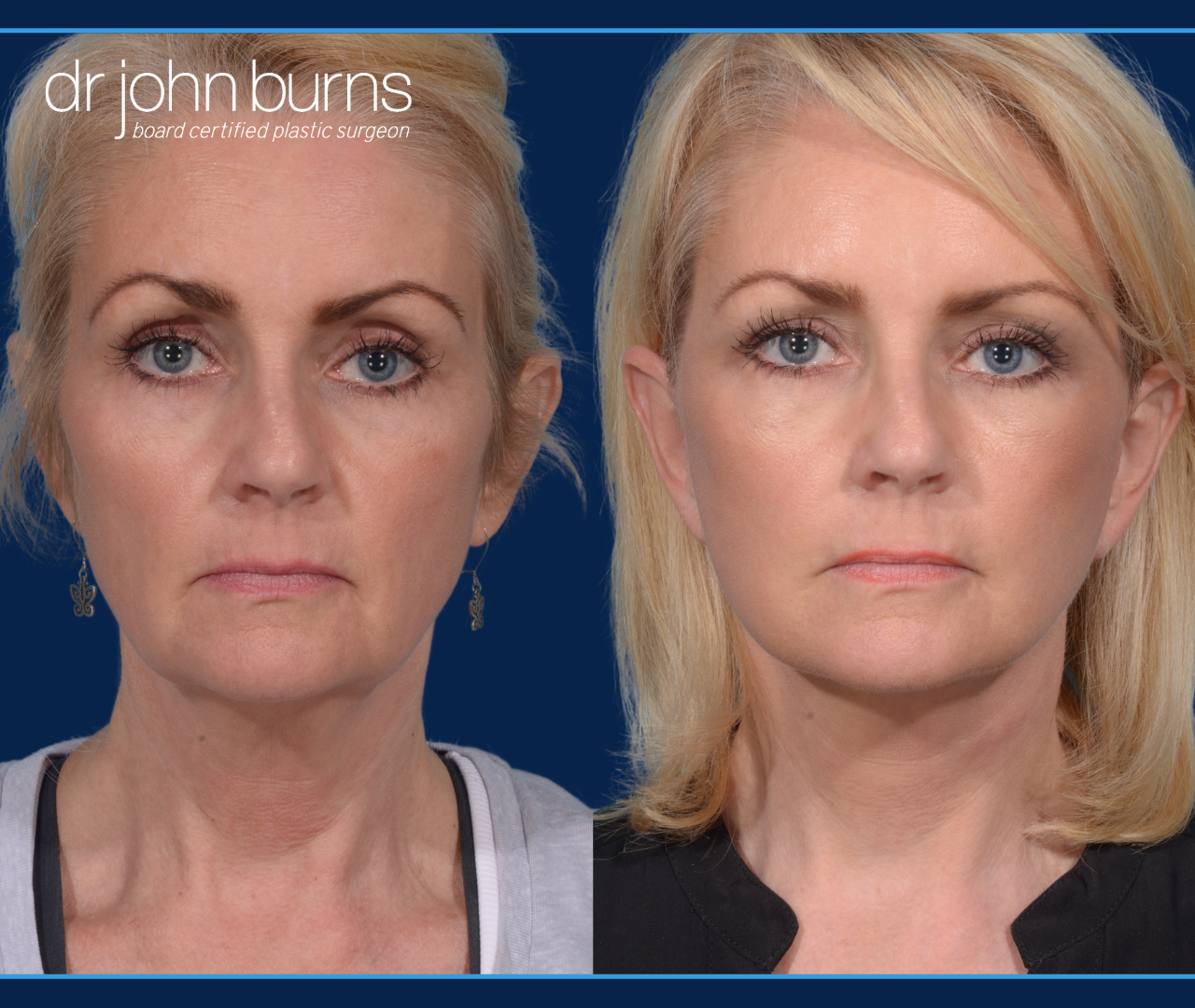 Before and After Mini Facelift by Dr. John Burns