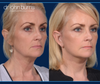 Before and After Mini Facelift by Dr. John Burns