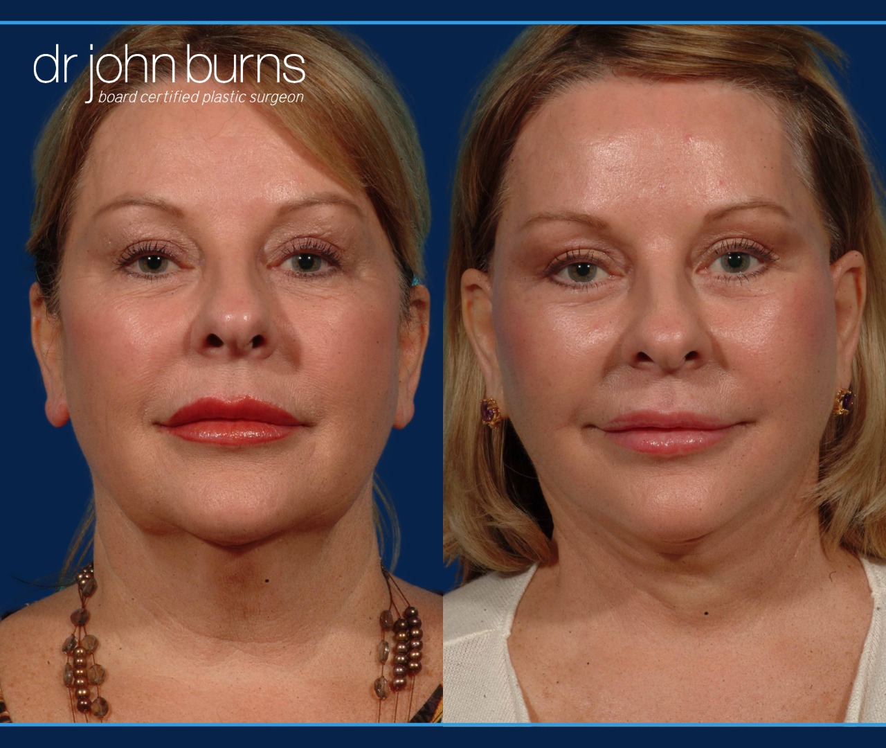 Before and After Full Facelift with Neck Lift, liposuction, Buccal Fat Removal and SMASectomy by Dr. John Burns