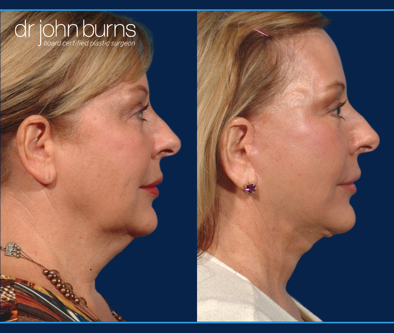 Profile View, Before and After Full Facelift with Neck Lift, liposuction, Buccal Fat Removal and SMASectomy by Dr. John Burns