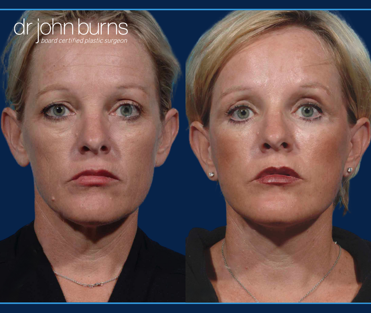 Before and After Mini Facelift- Dallas Facelift Surgeon, Dr. John Burns 
