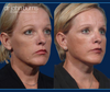 45 Degree View | Before and After Mini Facelift- Dallas Facelift Surgeon, Dr. John Burns 