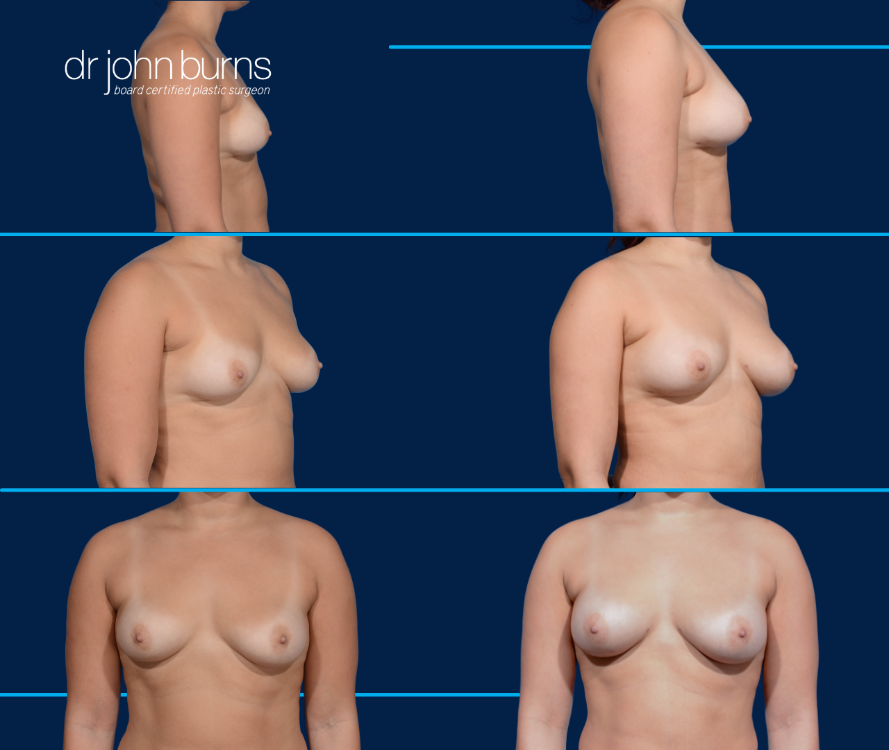 Fat Transfer to Breasts, 500cc per breast, by Dr. John Burns