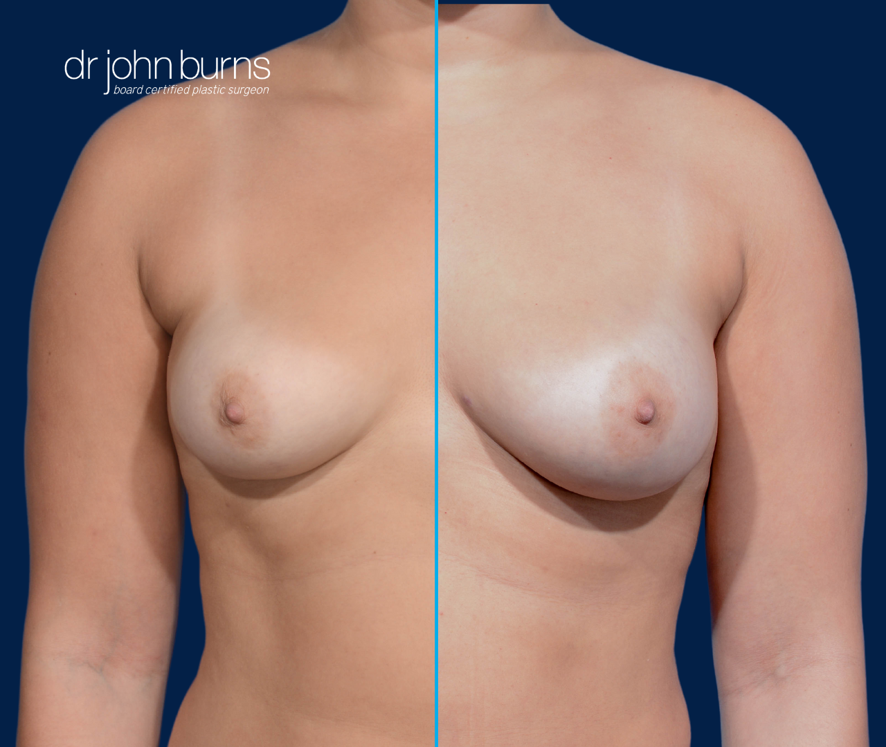 Split Screen Before and After Fat Transfer to Breasts Fat Transfer to Breasts, 500cc per breast, by Dr. John Burns