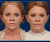 Before & After Facelift and neck lift by Facelift specialist in Dallas- Dr. John Burns, FACS