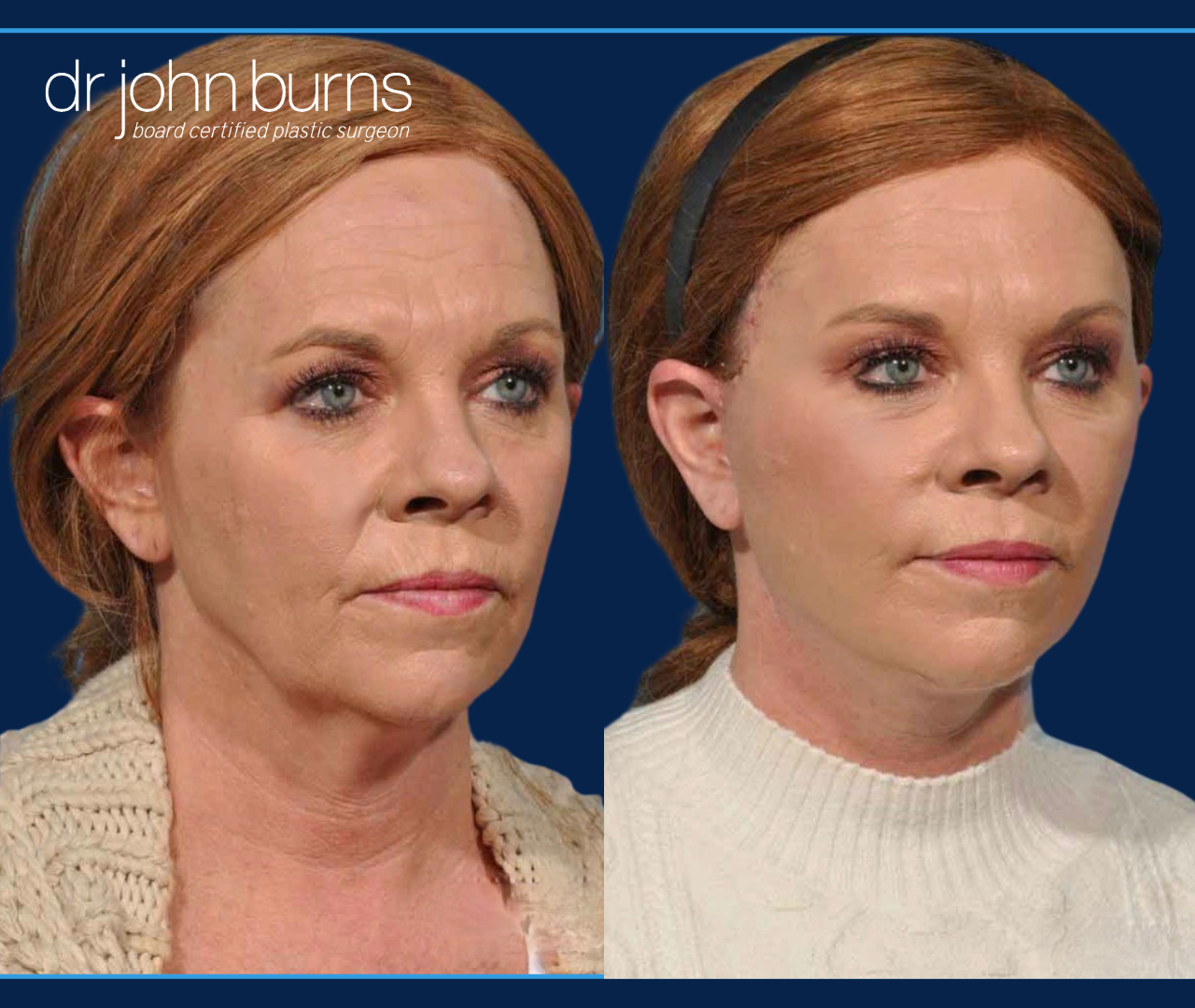 Before & After Facelift and neck lift by Dallas Facelift specialist Dr. John Burns, FACS