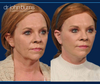 Before & After Facelift and neck lift by Dallas Facelift specialist Dr. John Burns, FACS